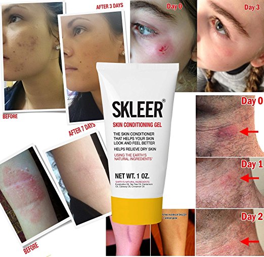 SKLEER positive results with before and afters - Large